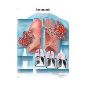  Pneumonia   Anatomical Chart
