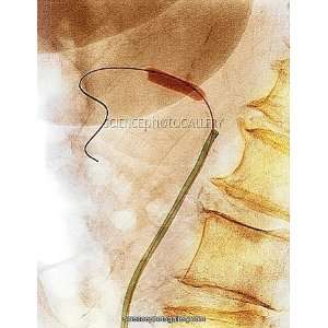  Balloon angioplasty, X ray Framed Prints