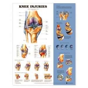 Knee Injuries Anatomical Chart Unmounted 9872PU  