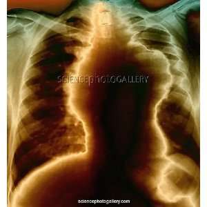  Non Hodgkinandamp;apos;s lymphoma, X ray Photographic 