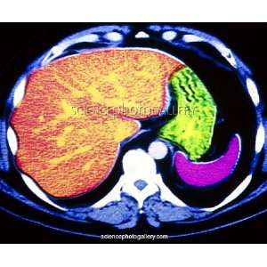  Coloured CT scan of human spleen, stomach and liver Canvas 